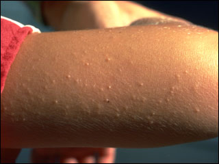 Keratosis pilaris