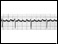 Electrocardiogram showing atrial flutter (rapid heart beat)