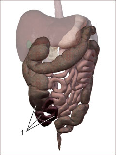 Necrotizing enterocolitis