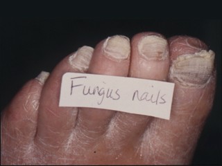 Fungus nail infection