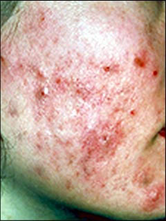 Acne vulgaris