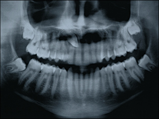 Impacted tooth