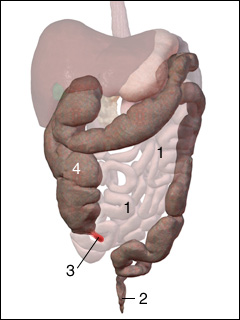 Appendicitis