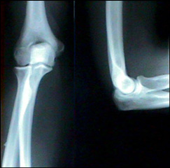 Joint X-ray of elbow