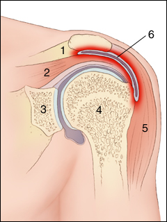 Bursitis