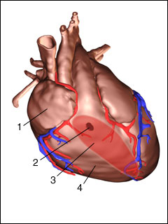 Ventricular Septal Defect