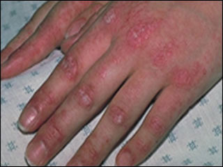 Dermatomyositis