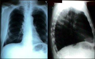 Chest X-ray (front and side views)