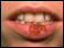 Oral herpes