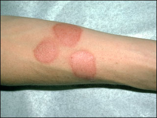 Contact dermatitis (on the arm)