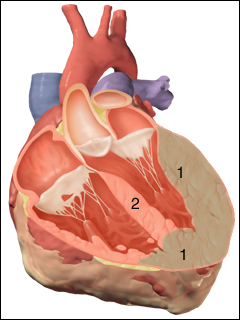 Cardiomyopathy