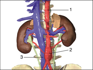 Abdominal aortic aneurysm