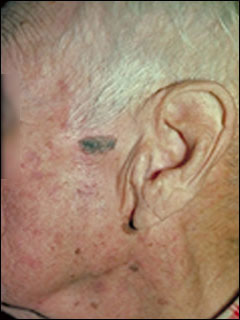 Seborrheic keratosis