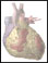 Aortic valve insufficiency