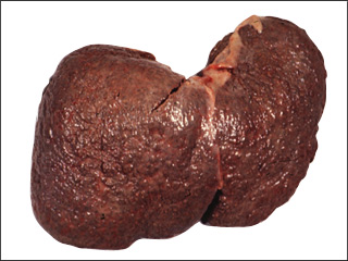 Cirrhosis of the liver