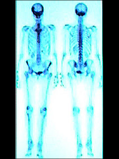 Bone scan