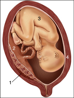 Placenta abruptio