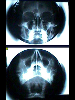 Sinuses X-ray