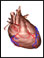 Atrial septal defect