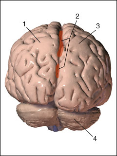 Deep intracerebral hemorrhage