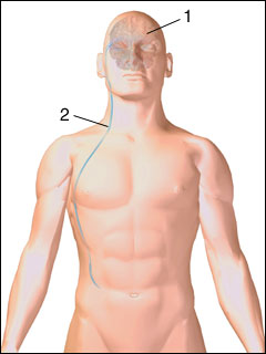 Ventriculoperitoneal shunt