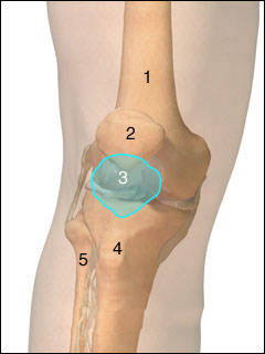 Patellar dislocation