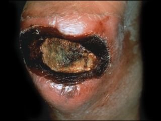 Diabetic foot ulcer