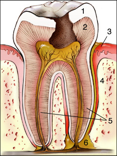Tooth with Abscess