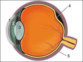 Retinal detachment