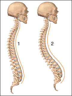 Lordosis