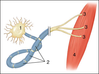 Multiple sclerosis