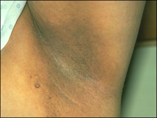 Acanthosis nigricans