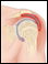 Bursitis