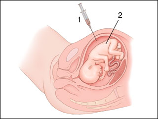 Amniocentesis