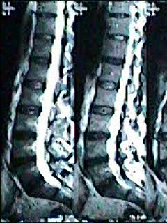 Lumbosacral spine MRI