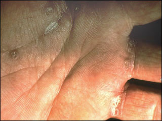 Secondary syphilis rash