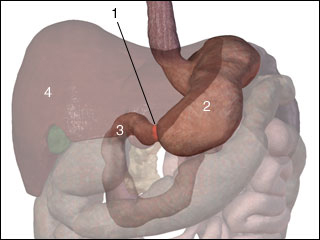 Pyloric stenosis