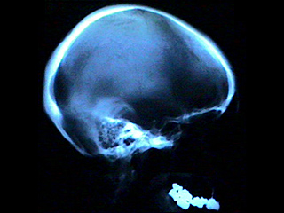 Skull X-ray