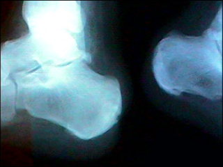 Osteomyelitis