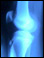 Osgood-Schlatter disease