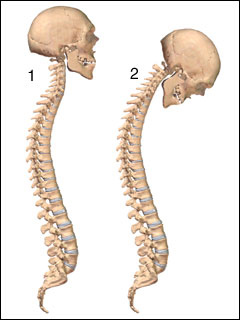 Ankylosing spondylitis