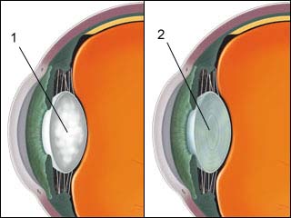 Cataract removal