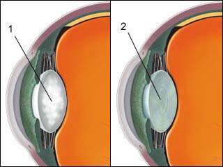 Cataract removal