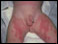 Erythema multiforme