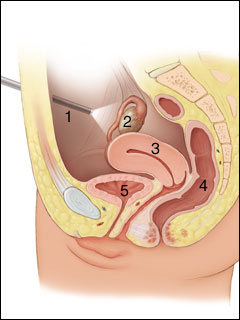 Hysteroscopy