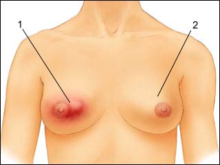 Breast infection