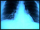 Lung X-ray
