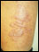 Stasis dermatitis