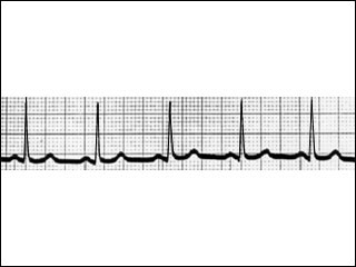 Electrocardiogram of a normal heart rhythm