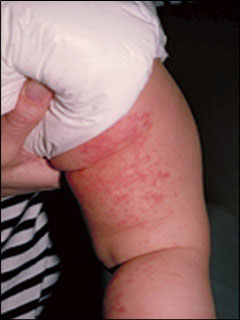 Atopic dermatitis